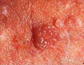 尖锐性湿疣吃瓜,揭秘吃瓜群众的健康警示